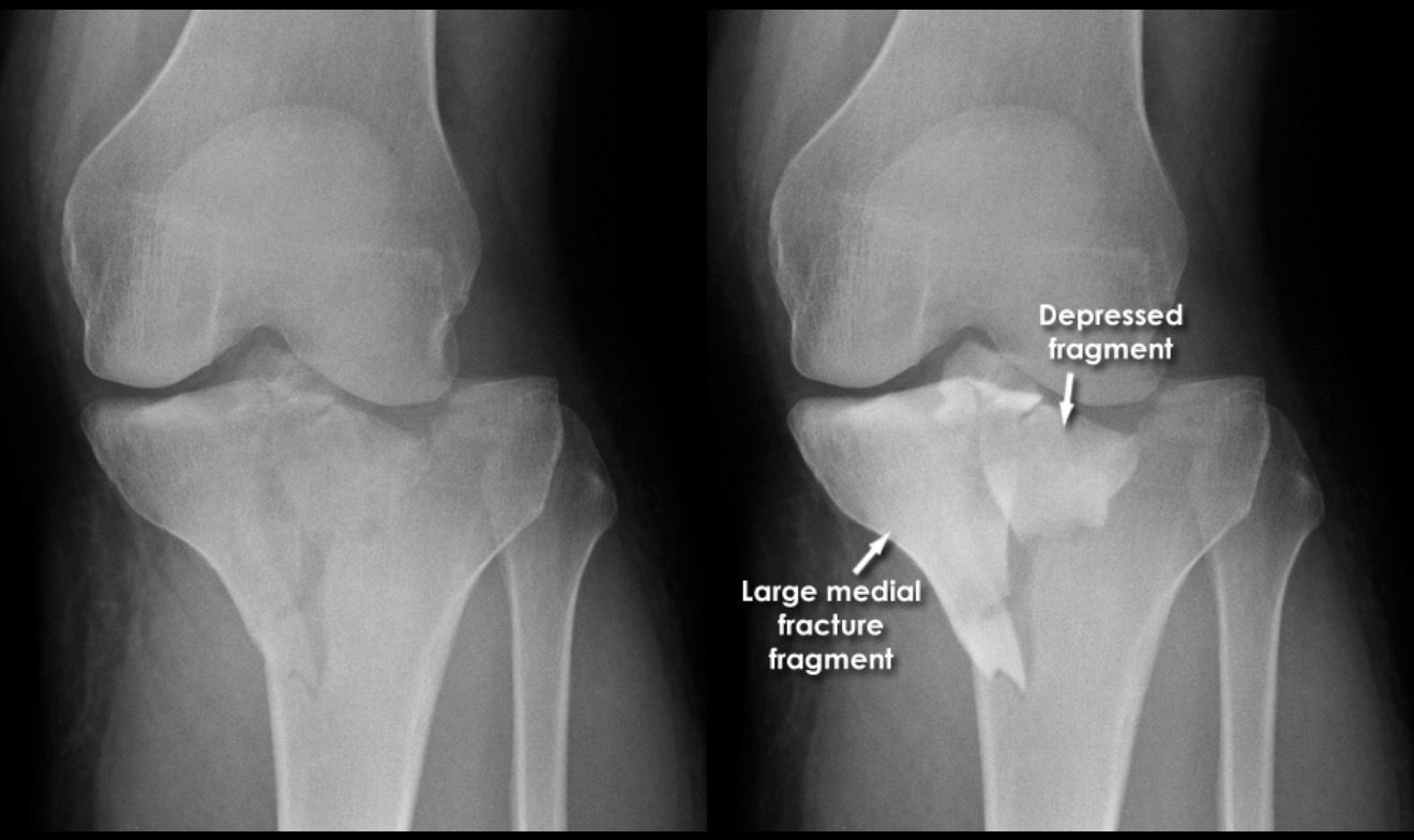 When to Choose Robotic-Assisted Surgery for Knee Fractures